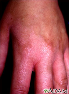 Dermatitis de fotocontacto de la mano