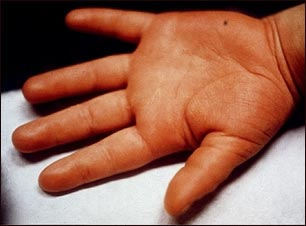 Enfermedad de Kawasaki - edema de la mano