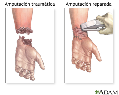 Reparación de amputación