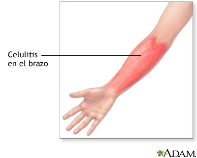 Celulitis en el brazo
