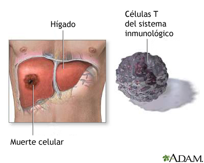 Muerte de las células hepáticas