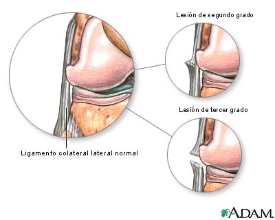 Lesión del ligamento colateral lateral