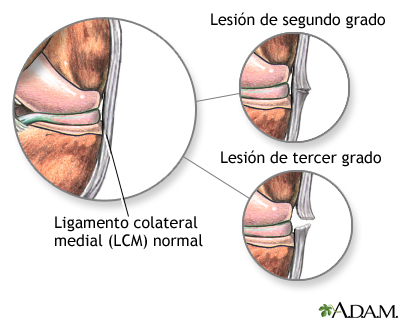 Lesión del ligamento medial colateral