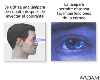 Examen de fluoresceína en el ojo