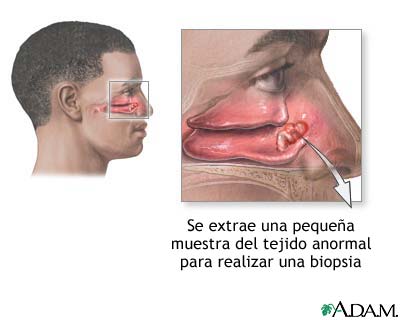 Biopsia nasal