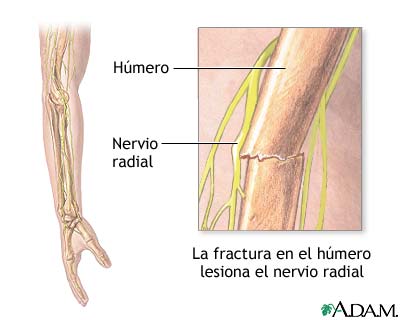 Disfunción del nervio radial