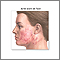 Cirugía para suavizar la superficie de la piel (dermabrasión) - Serie - Indicaciones