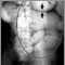 Ileo - Radiografía de la distensión intestinal