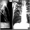 Tuberculosis, avanzada - radiografía de tórax