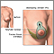 Elevación de mamas (mastopexia) - serie - Incisión