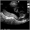 Ultrasonido, normal placenta relajada