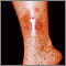 Dermatitis por estasis en la pierna