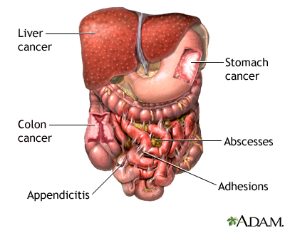 cancer abdominal adhesions plante naturiste