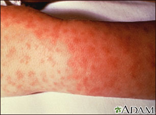 Rocky mountain spotted fever - lesions on arm