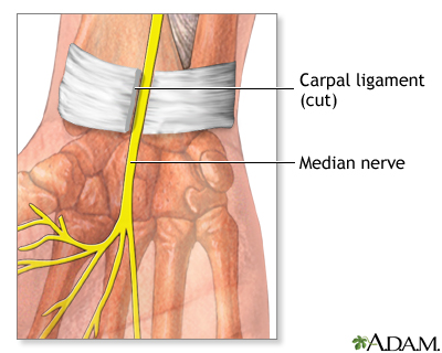 Carpal tunnel surgical procedure: MedlinePlus Medical Encyclopedia Image