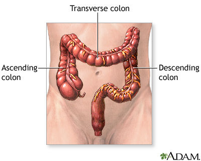 Large bowel resection - series
