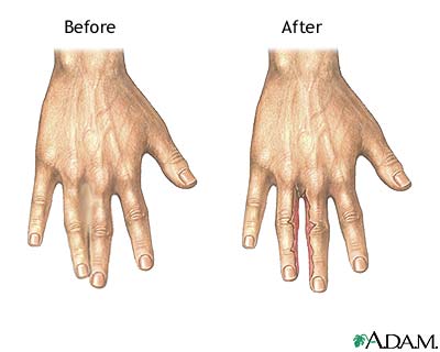 Webbed Fingers Webbed Fingers