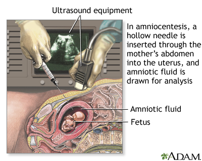 Amniocentesis