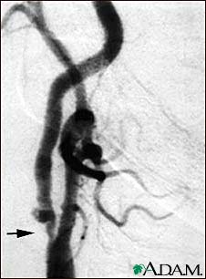 Carotid stenosis - X-ray of the right artery