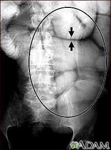 Ileus - X-ray of bowel distension