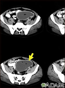 Intra-abdominal abscess - CT scan