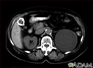 Kidney cyst with gallstones - CT scan