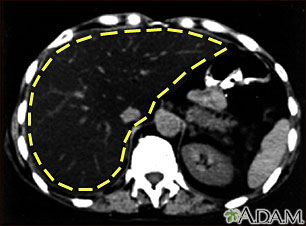 Fatty liver - CT scan