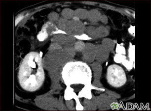 Lymphoma, malignant - CT scan