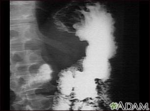 Abdominal x ray cancer. Rectal cancer x ray Gastric cancer x ray