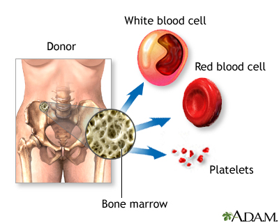 Bone-marrow transplant - series
