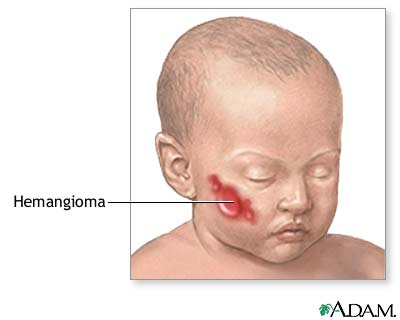 Hemangioma excision - series