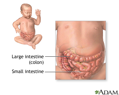 Intestinal obstruction (pediatric) - series