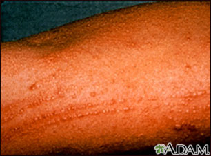 Poison oak rash on the arm: MedlinePlus Medical ...