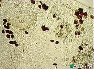 Scabies Mite Photomicrograph Of The Stool Medlineplus Medical