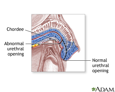 Hypospadias - Procedure