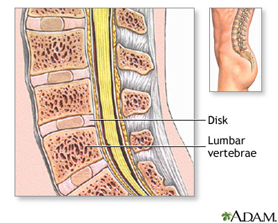 Spinal bone graft - series