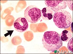 Chronic myelocytic leukemia - microscopic view