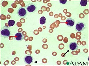 Hairy cell leukemia - microscopic view