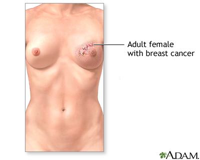 Breast reconstruction - series - Indication, part 1