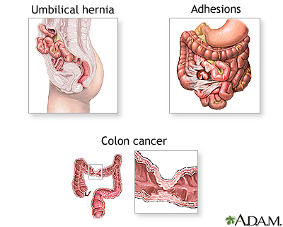 cancer abdominal adhesions que es cancer de pulmon