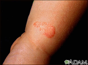 Ringworm - tinea corporis on an infant's leg