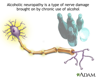 Alcoholic neuropathy