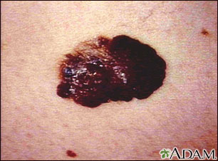 Skin cancer, melanoma - raised, dark lesion