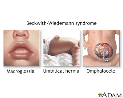 Beckwith-Wiedemann syndrome