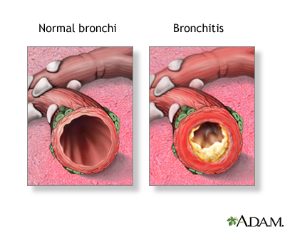 Acute bronchitis: MedlinePlus Medical Encyclopedia