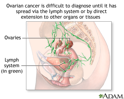 Ovarian cancer dangers