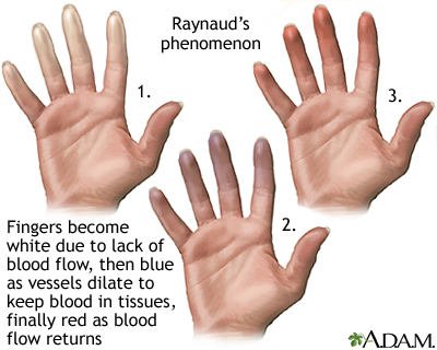 Raynaud's phenomenon