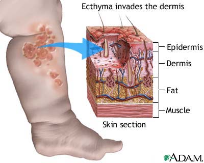 Ecthyma Vs Impetigo Impetigo Ecthyma Pediatric Signs And Symptoms 