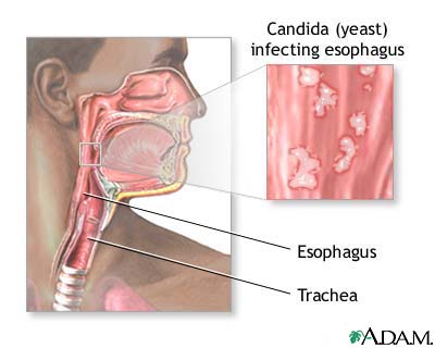 Candidal esophagitis
