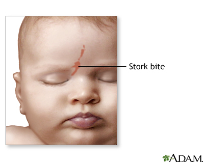 Stork Bite MedlinePlus Medical Encyclopedia